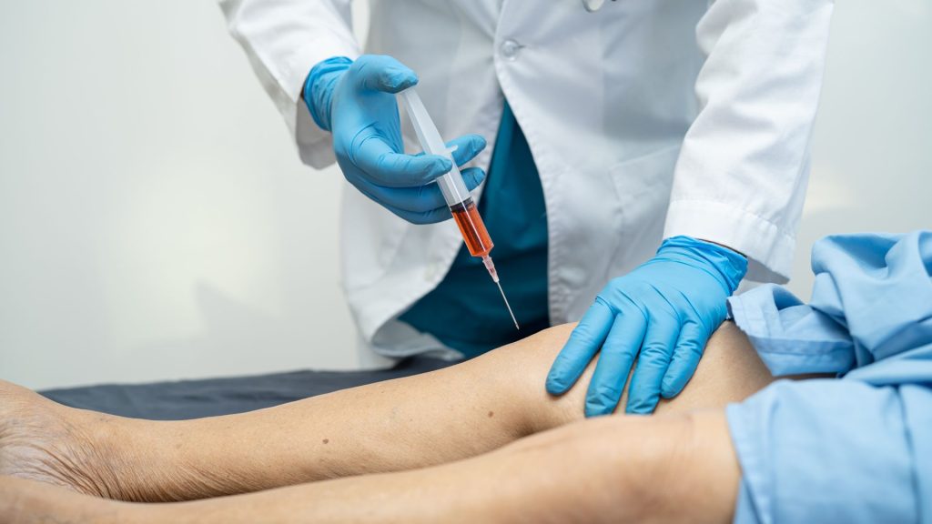 Mesenchymal Stem Cells for Knee Arthritis